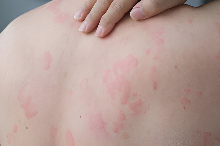 بثورات حرارتی